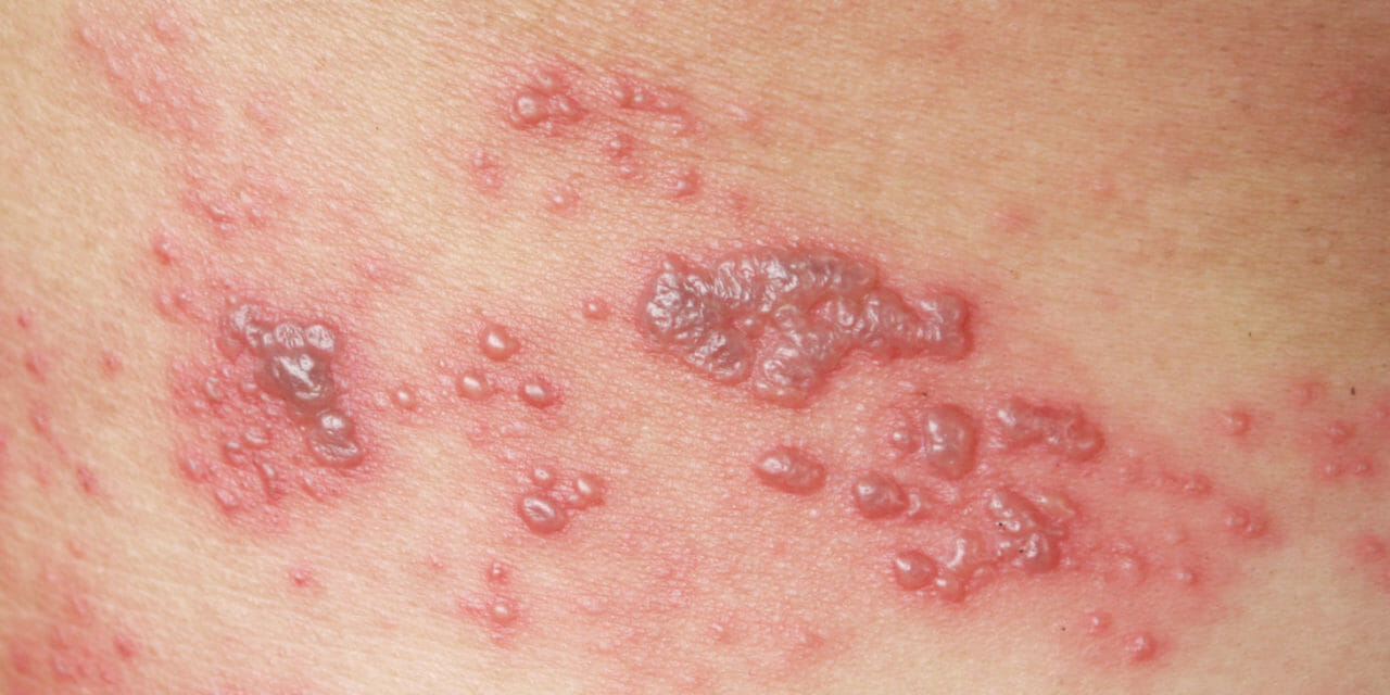 What You Should Know About The Shingles Vaccine