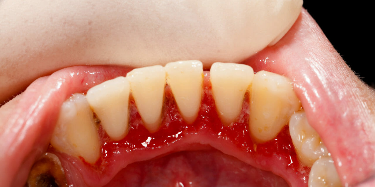 Gum Disease is Root of 5 Serious Health Issues