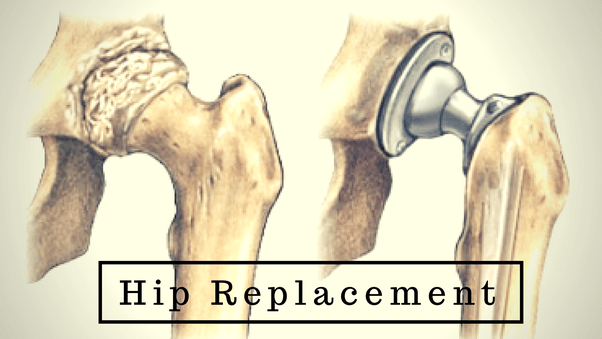 Hip, Knee Replacement Program Gets Gold Seal
