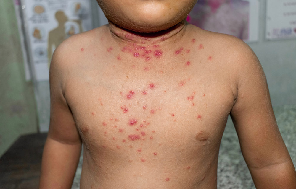 First Pediatric Case of Monkeypox Logged in RivCo