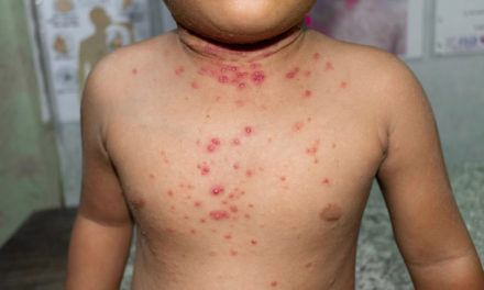 First Pediatric Case of Monkeypox Logged in RivCo